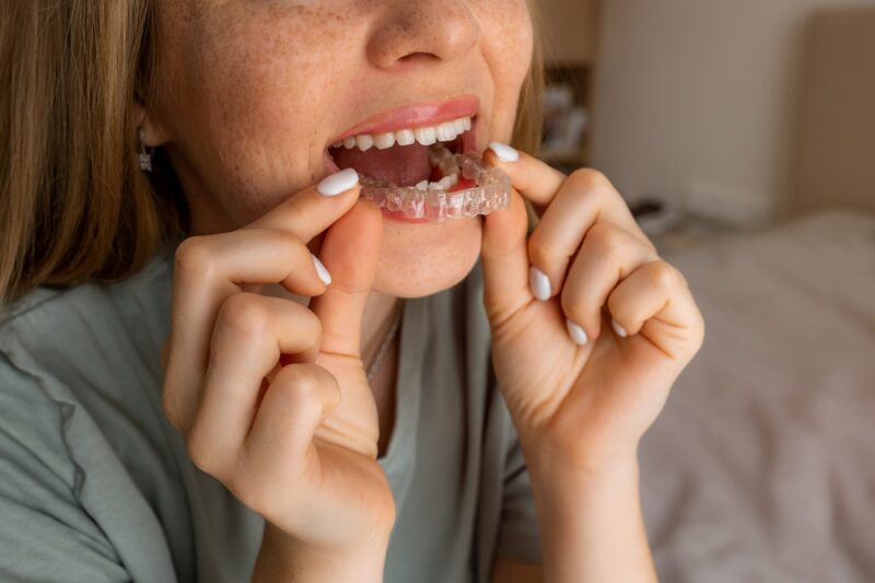 clear aligners burnet tx