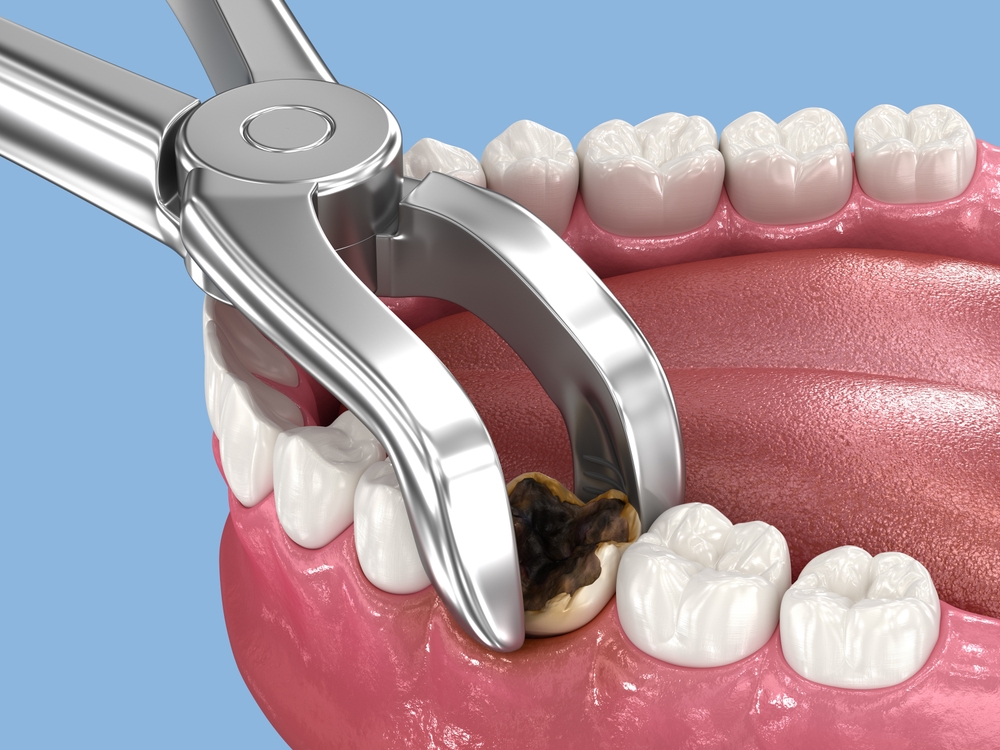 take out teeth price